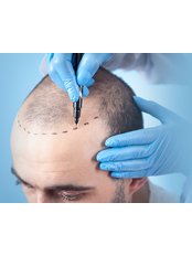 DHI - Direct Hair Implantation - Estheroyal