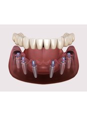 All-on-6 Dental Implants - Estheroyal
