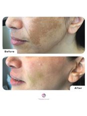 Pigmentation Treatment (facial and neck) - Dr. Hande Ulusal