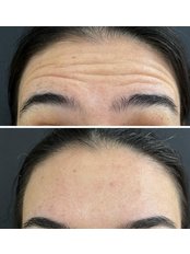 Treatment for Wrinkles - Dr Deniz Yavuz Klinik