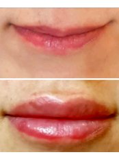 Lip Augmentation - Dr. Çiğdem Özden Clinic
