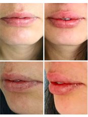 Lip Augmentation - Dr. Çiğdem Özden Clinic