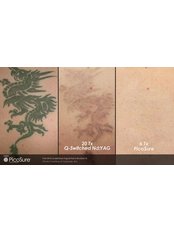 Tattoo Removal - Dr. HT Clinic