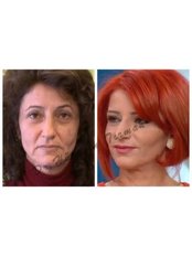 Non-Surgical Facelift - Dr. HT Clinic