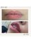 ONR Clinic - Lip Augmentation 