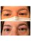 Dr. Safak Goktas - Non-surgical Eyelid Lift 