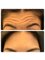 Dr. Safak Goktas - Forehead Anti-wrinkle treatment 
