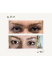 Non-Surgical Eye Lift with Thread - Caspian Clinic