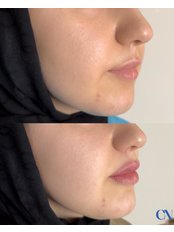 Lip Filler - Caspian Clinic