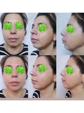 Chin Augmentation - Pervin Dinçer Beauty Consultancy Bakırköy