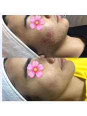 Spot (blemish) Treatments - Pervin Dinçer Beauty Consultancy Bakırköy