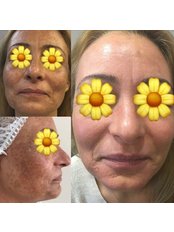 Spot (blemish) Treatments - Pervin Dinçer Beauty Consultancy Bakırköy