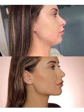 Chin Augmentation - Pervin Dinçer Beauty Consultancy Nişantaşı