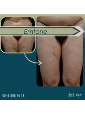 Cellulite Treatment - Dr Siyamek Saleki Esthetics