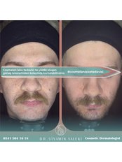 Face Pigmentation Treatment - Dr Siyamek Saleki Esthetics