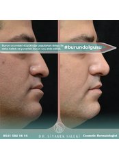 Non-Surgical Nose Job - Dr Siyamek Saleki Esthetics