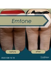 Cellulite Treatment - Dr Siyamek Saleki Esthetics