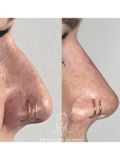 Non-Surgical Nose Job - Dr Hannah Jackman