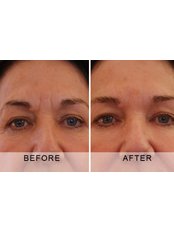 Treatment for Wrinkles - Dr Nicola Willis