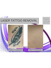 Tattoo Removal - Laser Aesthetics Clinic