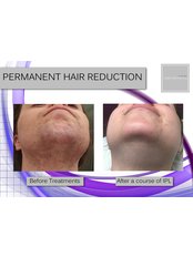 IPL Hair Removal - Laser Aesthetics Clinic