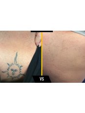 Tattoo Removal - LaserYou Aesthetics Laser Clinic