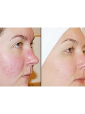 Rosacea Treatment - Skin Revision