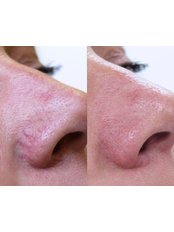 Facial Thread Veins Treatment - Skin Revision