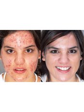 Acne Treatment - Skin Revision