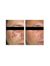 Birthmark Removal - The Chiltern Medical Clinic - Goring on Thames