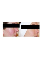 Rosacea Treatment - The Chiltern Medical Clinic - Goring on Thames