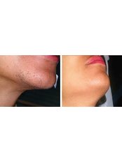 Laser Hair Removal - Lip - Package of 3  - The Chiltern Medical Clinic - Goring on Thames