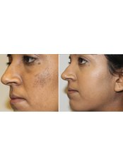 Pigmentation Consulation/Minor Surgery - The Chiltern Medical Clinic - Goring on Thames