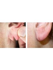 Torn earlobe repair - The Chiltern Medical Clinic - Goring on Thames