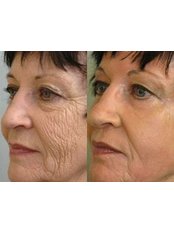 Deep Chemical Peel - The Chiltern Medical Clinic - Goring on Thames