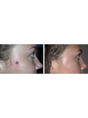 Mole Removal - The Chiltern Medical Clinic - Goring on Thames