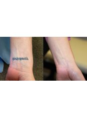 Tattoo Removal - The Chiltern Medical Clinic - Goring on Thames