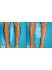 Laser Hair Removal - Full Legs - Package of 3 - The Chiltern Medical Clinic - Goring on Thames