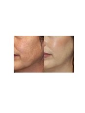 Microdermabrasion - The Chiltern Medical Clinic - Goring on Thames