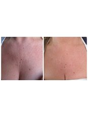 eDermaStamp DECOLLETTE (incl. DermaRoller mask, Neo Strata Bionic Face Cream, Heliocare SPF 50 Gel or Cream) - The Chiltern Medical Clinic - Goring on Thames