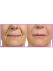 Dermal Fillers - The Chiltern Medical Clinic - Goring on Thames