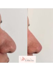 Non-Surgical Nose Job - Dr Wafaa Clinic