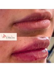 Lip Augmentation - Dr Wafaa Clinic