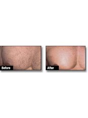 Laser Hair Removal - Chest (Half) - Package of 6 - The Chiltern Medical Clinic - Central Reading
