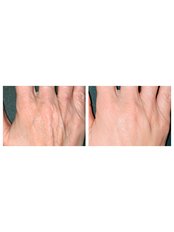 eDermaStamp HANDS (incl. Neo Strata Bionic Face Cream) - The Chiltern Medical Clinic - Central Reading