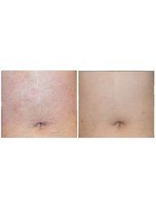 Laser Hair Removal - Abdomen - Package of 3 - The Chiltern Medical Clinic - Central Reading