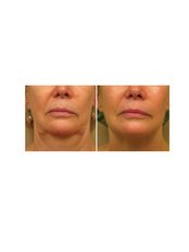 Laser Skin Tightening - The Chiltern Medical Clinic - Central Reading