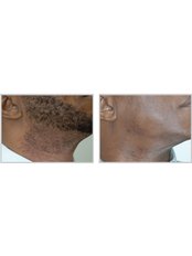 Laser Hair Removal - Front of Neck - Package of 3  - The Chiltern Medical Clinic - Central Reading