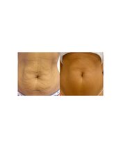 Laser Skin Tightening - The Chiltern Medical Clinic - Central Reading