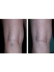 Spider Veins Treatment - The Chiltern Medical Clinic - Central Reading